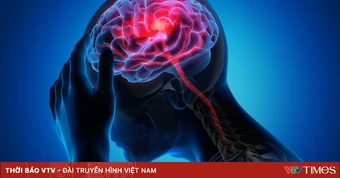 Cẩn trọng khi sơ cứu đột quỵ bằng phương pháp dân gian