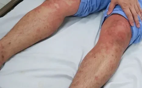 Cẩn trọng với mối nguy phản vệ do côn trùng đốt mùa hè Cẩn trọng với mối nguy phản vệ do côn trùng đốt mùa hè