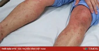 Cẩn trọng với mối nguy phản vệ do côn trùng đốt mùa hè