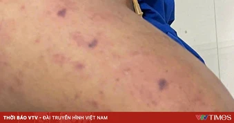 Cảnh báo bệnh não mô cầu gia tăng