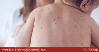 Cảnh báo bệnh truyền nhiễm vẫn khó lường trong mùa hè 2026