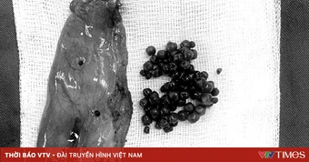 Cảnh báo biến chứng nguy hiểm từ sỏi túi mật
