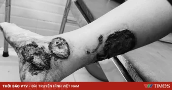 Cảnh báo bỏng nặng do tự ý đắp thuốc nam