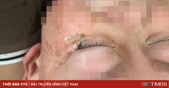 Cảnh báo chấn thương mắt do móc câu cá ở trẻ nhỏ