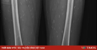 Cảnh báo nguy cơ nhiễm ấu trùng sán dây lợn