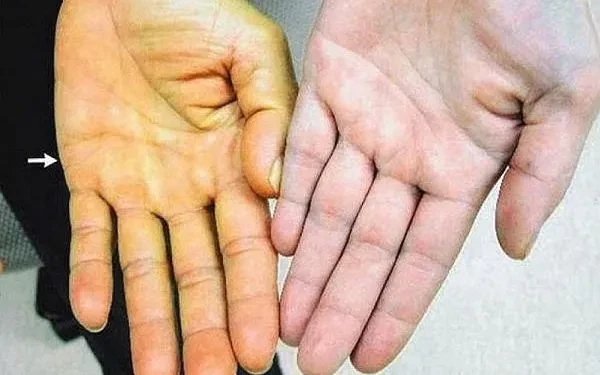 Cảnh báo nguy cơ suy gan từ thảo dược trôi nổi Cảnh báo nguy cơ suy gan từ thảo dược trôi nổi