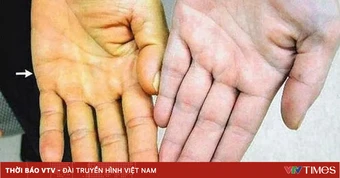 Cảnh báo nguy cơ suy gan từ thảo dược trôi nổi