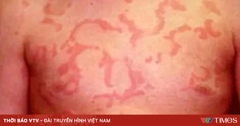 Cảnh báo nguy cơ từ việc lạm dụng corticoid trị mày đay