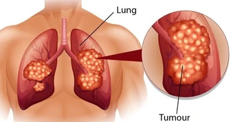 Cảnh báo sớm ung thư phổi qua những tín hiệu nhỏ của cơ thể