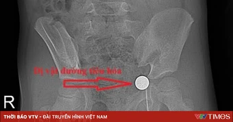 Cảnh báo trẻ nuốt dị vật nguy hiểm