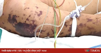 Cảnh giác viêm màng não do não mô cầu