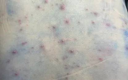 Cảnh giác với biến chứng nguy hiểm khi mắc bệnh thủy đậu Cảnh giác với biến chứng nguy hiểm khi mắc bệnh thủy đậu