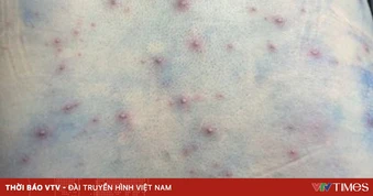 Cảnh giác với biến chứng nguy hiểm khi mắc bệnh thủy đậu