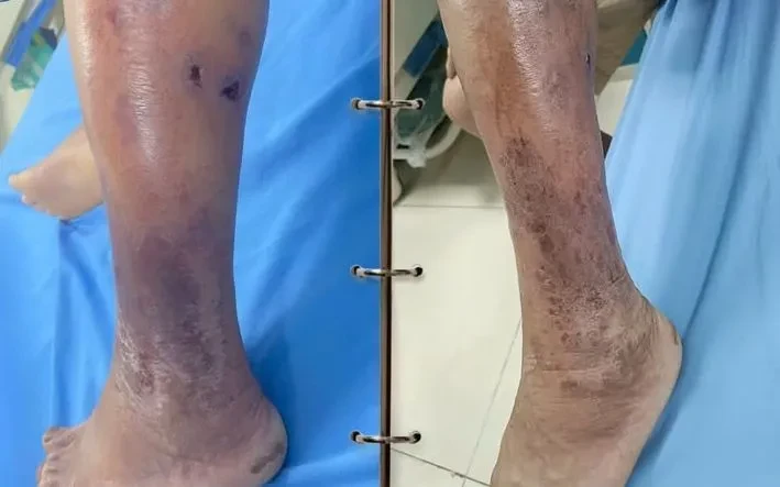 Cảnh giác với nguy cơ nhiễm khuẩn khi vết thương tiếp xúc với bùn đất Cảnh giác với nguy cơ nhiễm khuẩn khi vết thương tiếp xúc với bùn đất
