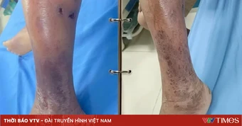 Cảnh giác với nguy cơ nhiễm khuẩn khi vết thương tiếp xúc với bùn đất