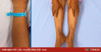 Cảnh giác với nguy cơ tổn thương gan do tự ý sử dụng thuốc nam