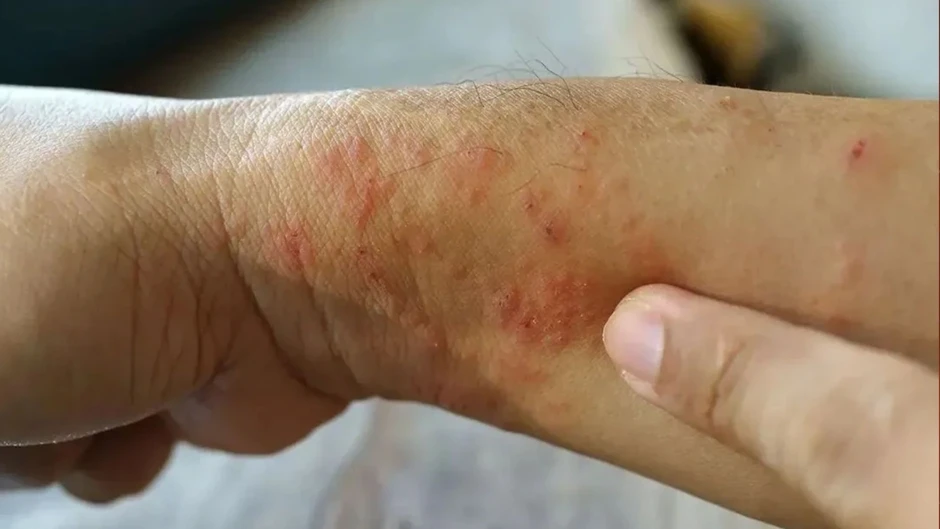 Cảnh giác với “sốt đất” khi mầm bệnh ẩn trong bùn đất và nước tù đọng Cảnh giác với “sốt đất” khi mầm bệnh ẩn trong bùn đất và nước tù đọng