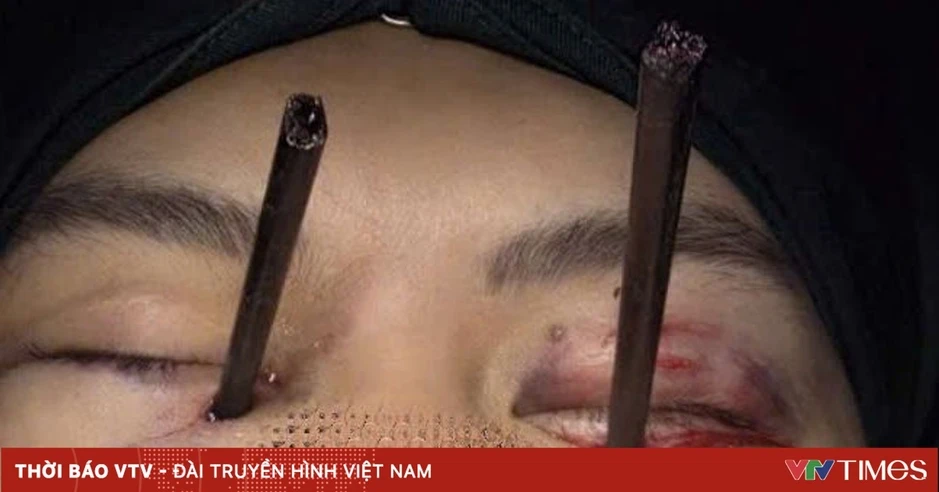 Cấp cứu nam thanh niên bị 2 chiếc đũa đâm sâu vào mắt Cấp cứu nam thanh niên bị 2 chiếc đũa đâm sâu vào mắt