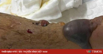 Cấp cứu thành công một ca bị rắn hổ bướm cắn, nguy cơ biến chứng nặng