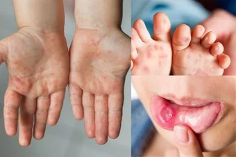 Cấp phép lưu hành vaccine phòng ngừa bệnh tay chân miệng