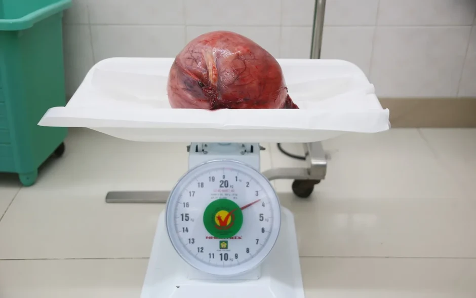 Cắt khối u xơ tử cung khổng lồ cho bệnh nhân 53 tuổi Cắt khối u xơ tử cung khổng lồ cho bệnh nhân 53 tuổi