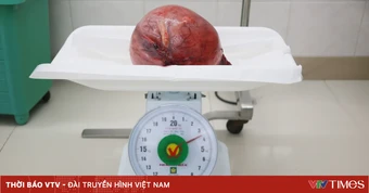 Cắt khối u xơ tử cung khổng lồ cho bệnh nhân 53 tuổi