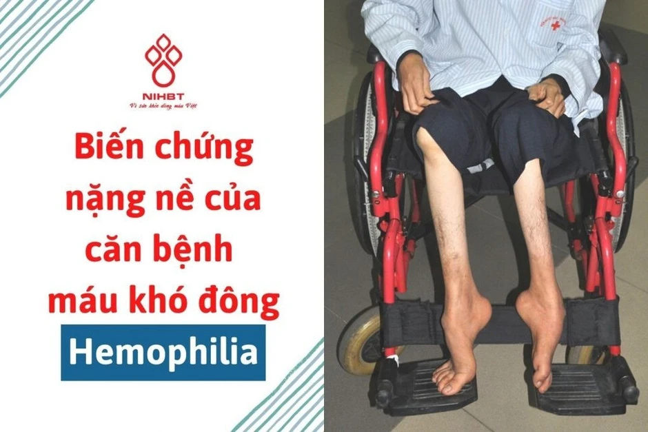 Câu chuyện vượt lên nghịch cảnh của những chàng trai mắc bệnh máu khó đông Câu chuyện vượt lên nghịch cảnh của những chàng trai mắc bệnh máu khó đông