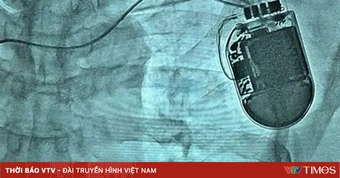 Cấy máy phá rung tim cứu cụ ông thoát nguy cơ đột tử