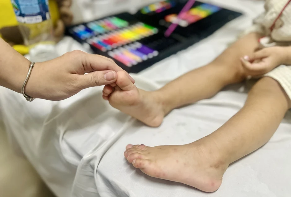 Chăm sóc trẻ mắc tay chân miệng tại nhà Chăm sóc trẻ mắc tay chân miệng tại nhà