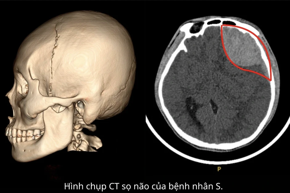 Chàng trai 18 tuổi tỉnh táo lúc tai nạn, nhưng hôm sau đột ngột nguy kịch Chàng trai 18 tuổi tỉnh táo lúc tai nạn, nhưng hôm sau đột ngột nguy kịch