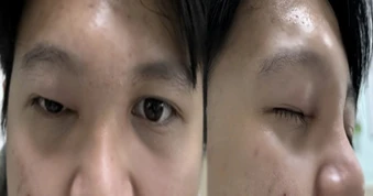 Chàng trai bỗng bị hủy xương vùng mặt, suýt mất mạng sau khi chảy mũi đục