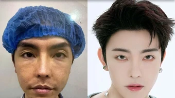 Chàng trai 'lột xác' sau 20 lần dao kéo thẩm mỹ