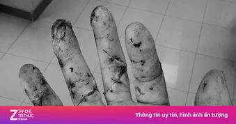 Chàng trai ở TP.HCM vào viện thương tâm với 3 ngón tay gần đứt lìa