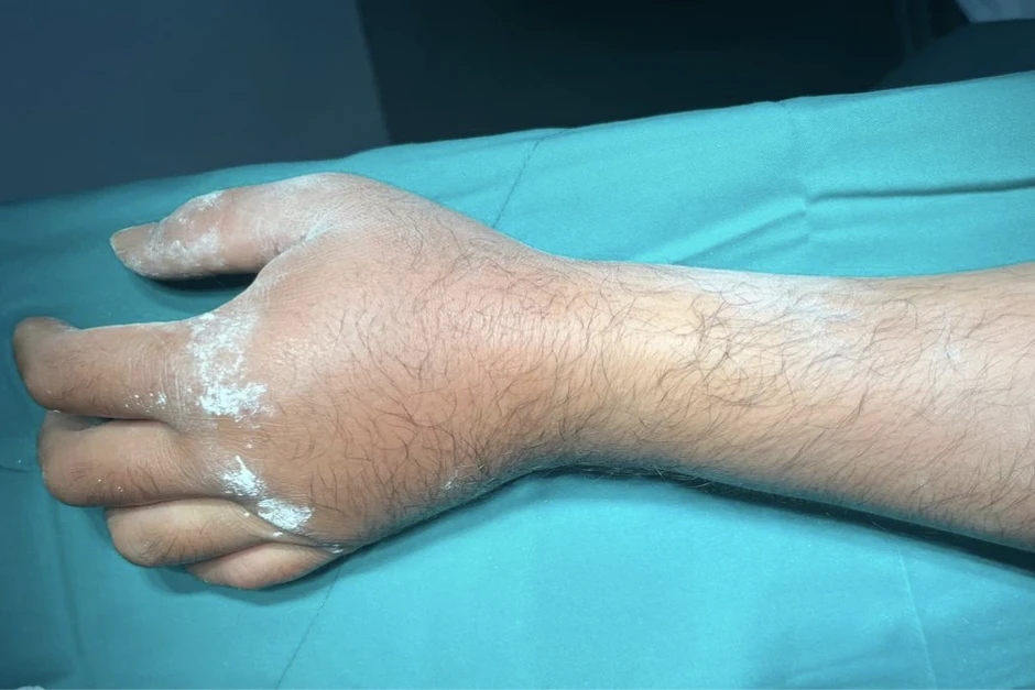 Chống tay khi ngã xe máy, nhiều người phải lên bàn mổ ở TPHCM Chống tay khi ngã xe máy, nhiều người phải lên bàn mổ ở TPHCM