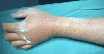 Chống tay khi ngã xe máy, nhiều người phải lên bàn mổ ở TPHCM