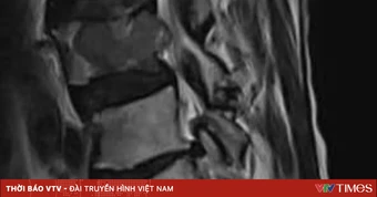 Chủ quan đau lưng kéo dài, phát hiện ung thư di căn cột sống