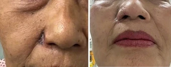 Chủ quan với nốt ruồi nhiều năm, người phụ nữ suýt mất cánh mũi vì ung thư da