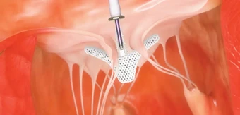 Chữa hở van tim ba lá bằng công nghệ TriClip - dấu mốc quan trọng trong y học châu Phi