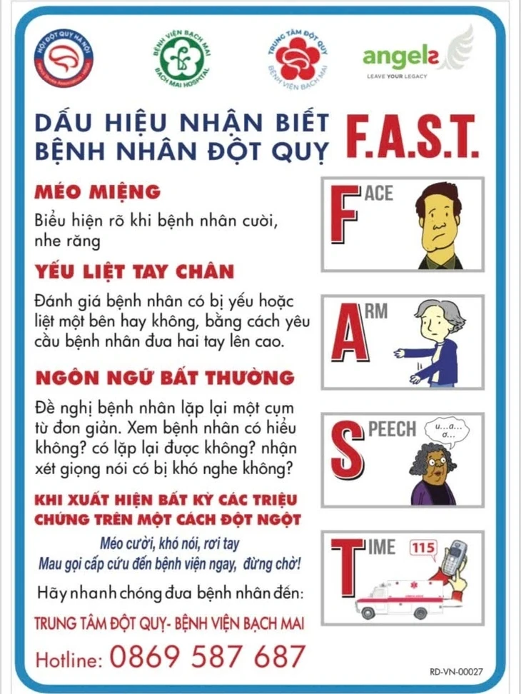 Chuyên gia cảnh báo dấu hiệu mờ nhạt trước cơn đột quỵ, cần biết để an toàn Chuyên gia cảnh báo dấu hiệu mờ nhạt trước cơn đột quỵ, cần biết để an toàn