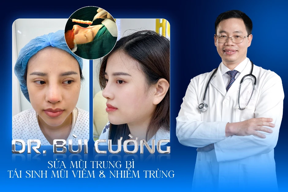 Chuyên gia chia sẻ giải pháp tái cấu trúc mũi lỗi hỏng sau nâng Chuyên gia chia sẻ giải pháp tái cấu trúc mũi lỗi hỏng sau nâng