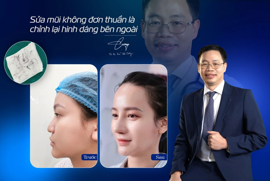 Chuyên gia chia sẻ giải pháp tái cấu trúc mũi lỗi hỏng sau nâng Chuyên gia chia sẻ giải pháp tái cấu trúc mũi lỗi hỏng sau nâng