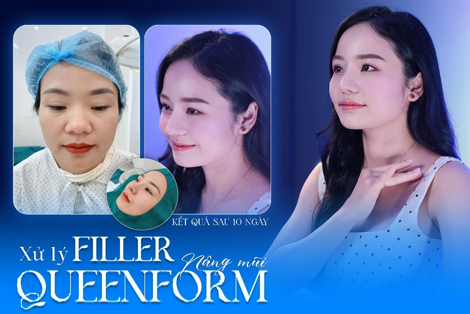 Chuyên gia chia sẻ giải pháp tái cấu trúc mũi lỗi hỏng sau nâng Chuyên gia chia sẻ giải pháp tái cấu trúc mũi lỗi hỏng sau nâng