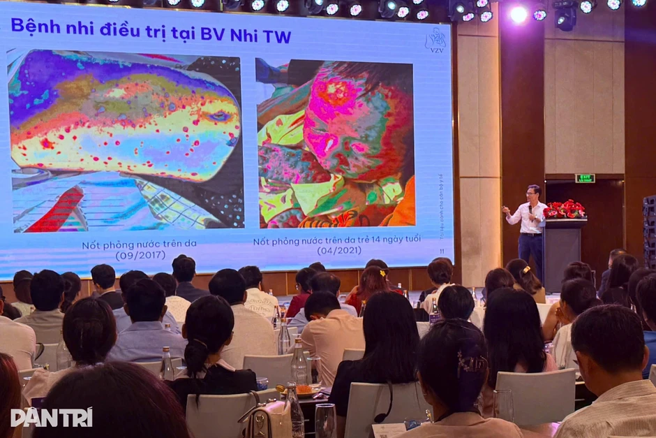 Chuyên gia: Thủy đậu không "lành tính", gây nhiều biến chứng nghiêm trọng Chuyên gia: Thủy đậu không "lành tính", gây nhiều biến chứng nghiêm trọng