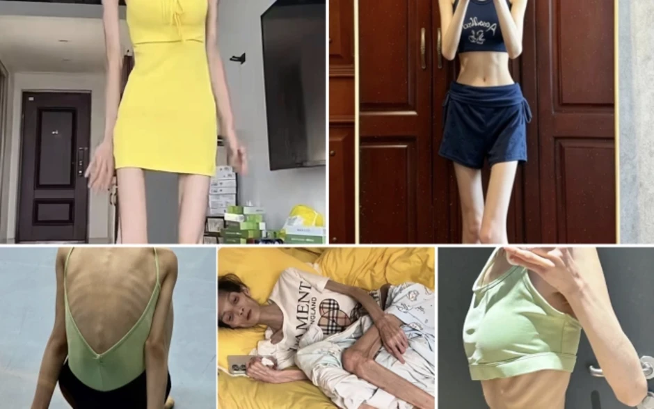 Cô gái 23 tuổi suy kiệt, mất kinh vì tiêm thuốc giảm cân