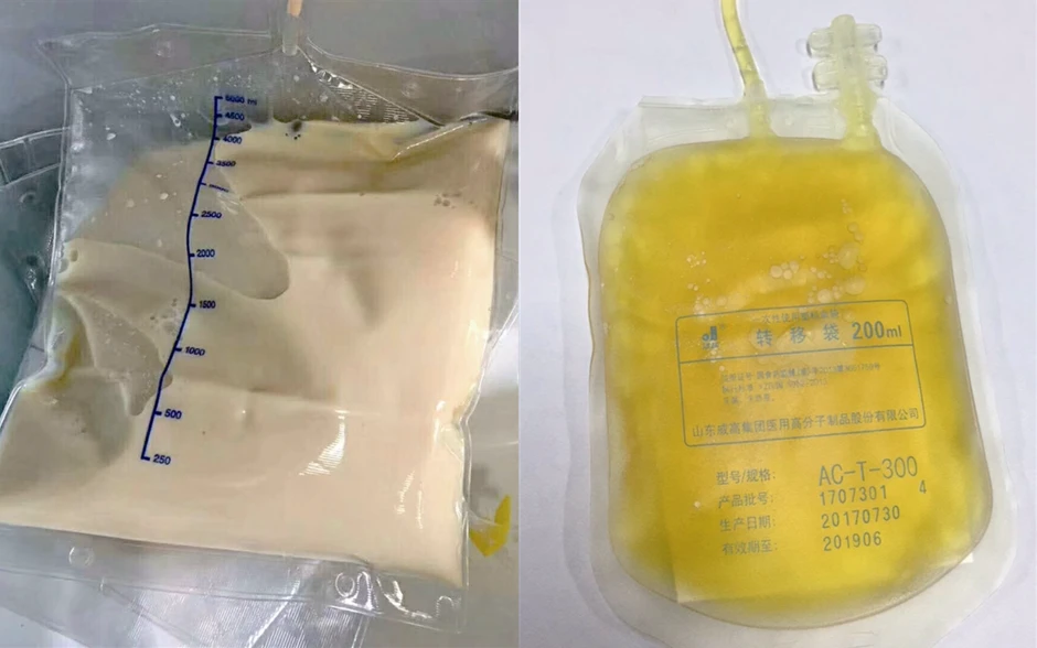 Cô gái 27 tuổi máu đục như trà sữa, "ngập dầu" vì kiểu ăn uống tiện lợi với nhiều người Việt trẻ Cô gái 27 tuổi máu đục như trà sữa, "ngập dầu" vì kiểu ăn uống tiện lợi với nhiều người Việt trẻ