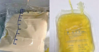 Cô gái 27 tuổi máu đục như trà sữa, "ngập dầu" vì kiểu ăn uống tiện lợi với nhiều người Việt trẻ