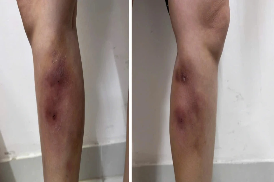 Cô gái gặp họa vì tiêm filler "nắn thẳng chân" Cô gái gặp họa vì tiêm filler "nắn thẳng chân"