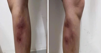 Cô gái gặp họa vì tiêm filler "nắn thẳng chân"