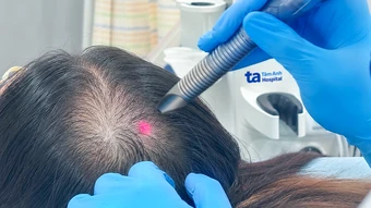 Cô gái hói đầu do hormone nam tăng cao - Báo TinVina