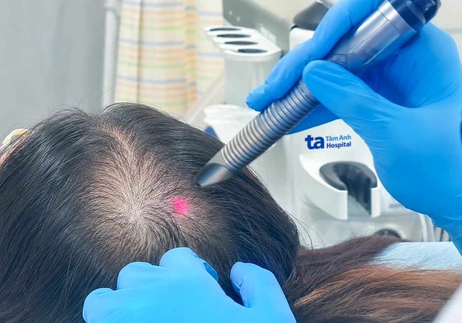 Cô gái hói đầu do hormone nam tăng cao - Báo TinVina Cô gái hói đầu do hormone nam tăng cao - Báo TinVina